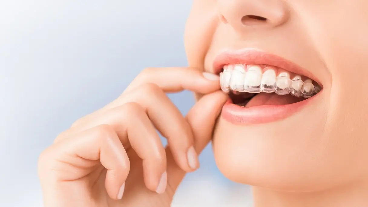 A guide on how clear aligners work and what they treat What are clear aligners and how do they work