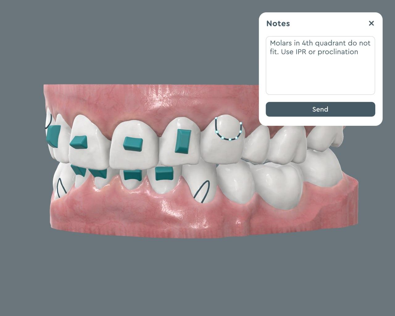 3D aligner treatment plan visualized on the SoftSmile platform