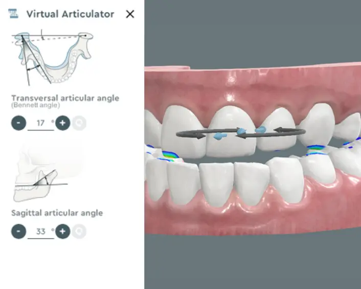 Virtual Articulator Feature