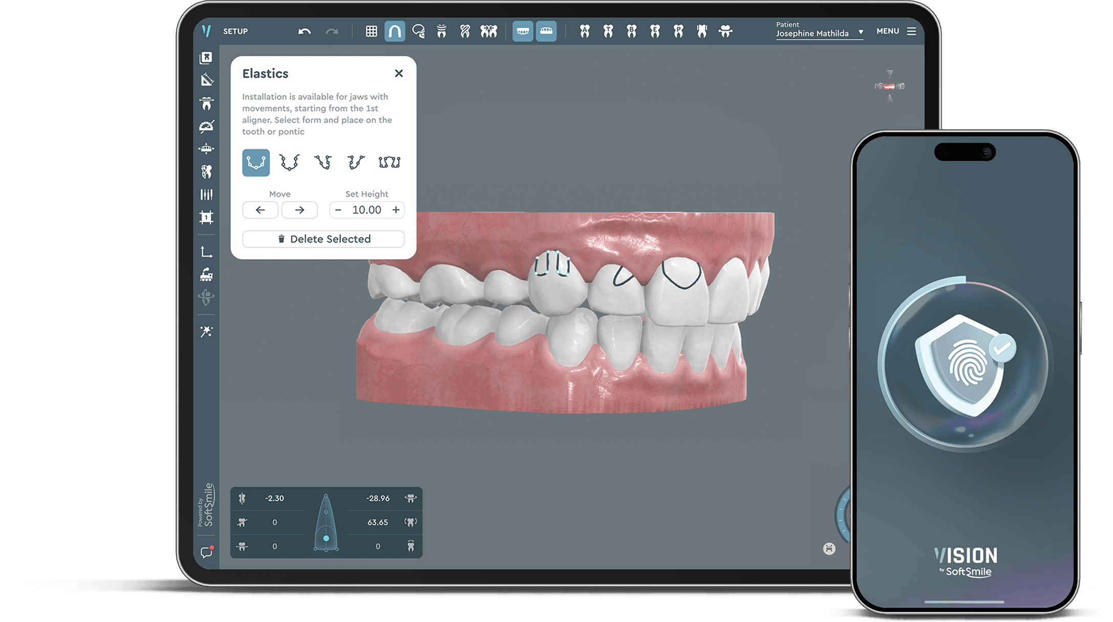 SoftSmile — Desktop and app interface Aligner treatment planning software