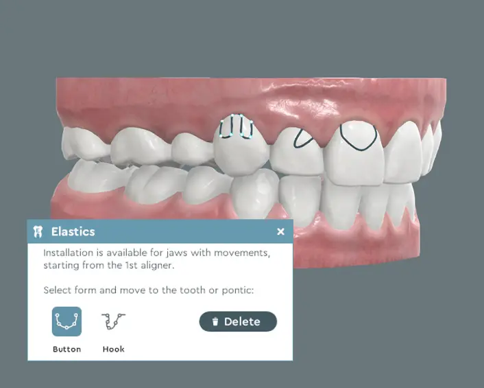 Treatment plan showing placement of elastics and attachments